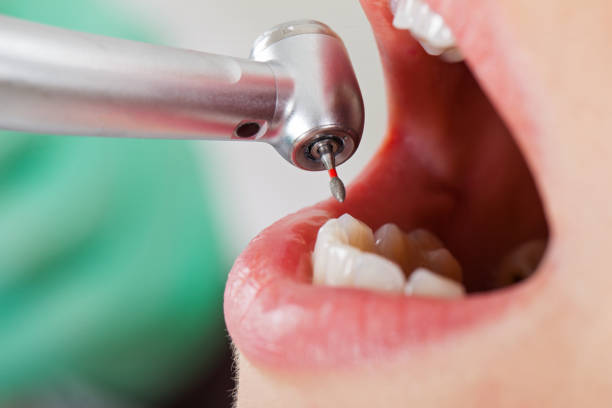 Best Chipped Tooth Repair Near Me  in Normandy, MO